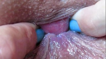 Кровь анальное отверстие